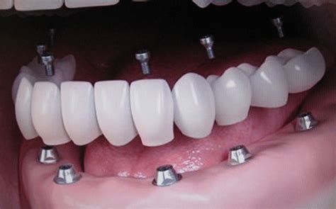 Ugradnja Implantata Dental Implant Expert