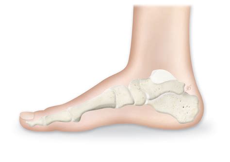 Charcot Foot And Ankle Limbhealing