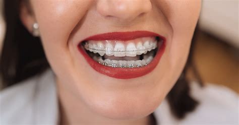 Braces And Gum Recession Splash Orthodontics