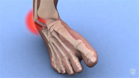 Ankle Sprainstrain Carolina Regional Orthopedics