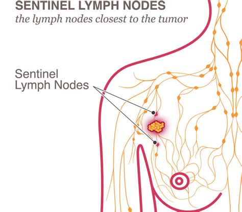 Lymph Node Removal Lymphedema National Breast Cancer Foundation