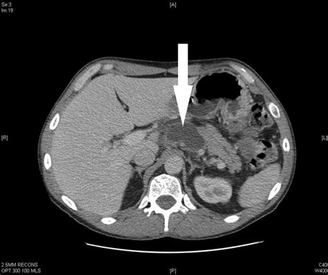 It allows distinction between free and loculated fluid showing its extent and localization. Massive loculated pleural effusion in a patient with pancreatic pseudocyst due to alcohol ...