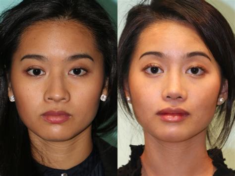 Rhinoplasty Photos Chevy Chase Md Patient