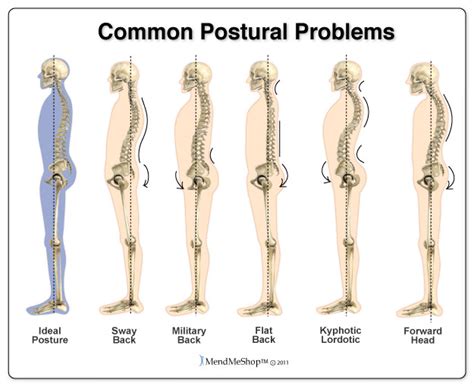 Poor Posture How To Improve Posture Pamikahar Safalika