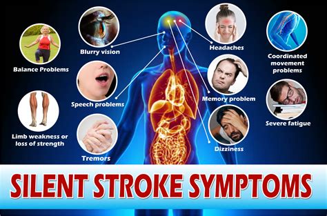 Silent Stroke Symptoms 10 Unnoticeable Signs Of Silent Mini Stroke