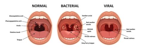 Tonsils What They Do And Why You Might Have To Remove Them Nadim