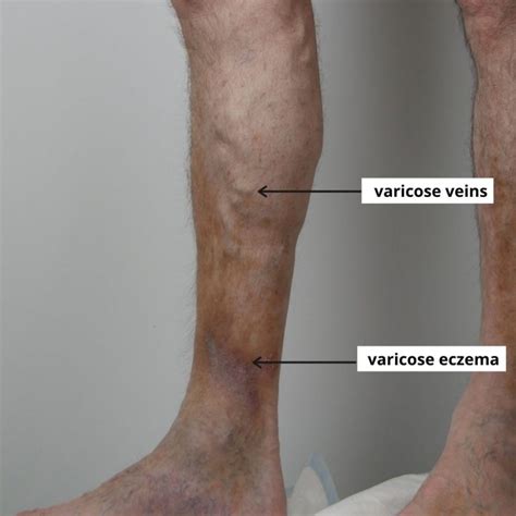 Varicose Eczema The Veincare Centre