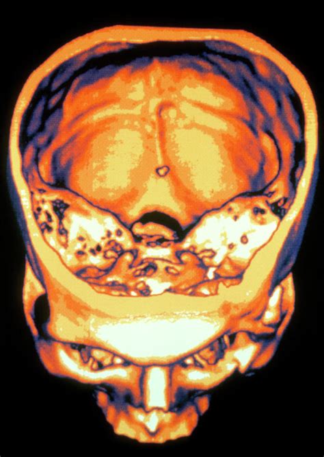 3 D Ct Scan Of Human Skull Photograph By Gcascience Photo Library