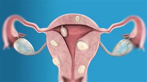 • intramurale myomen ontwikkelen zich binnen in de baarmoederwand zodat de baarmoeder groter voelt dan normaal. Myomen - Vuurvrouw