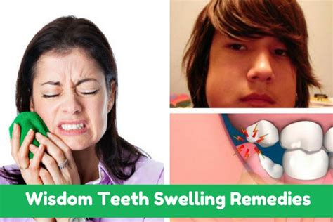 Best Way To Reduce Swelling After Wisdom Tooth Extraction Health