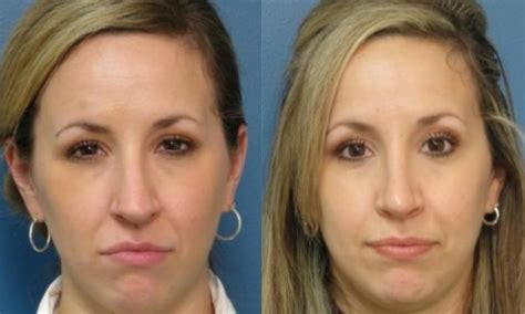 How Long Does Swelling Last After Rhinoplasty Surgery Rhinoplasty