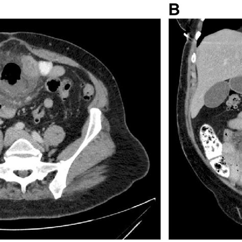 Ct Of The Abdomen With Oral And Iv Contrast A Axial Image Of The