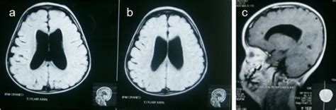 47 xxy 48 xxxy 49 xxxxy mosaic with hydrocephaly a case report and review of the literature