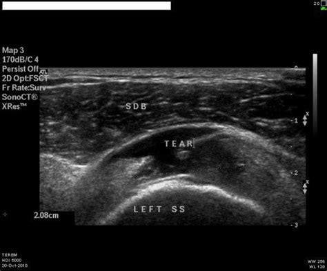Ultrasound Image Gallery Tear Of Supraspinitus Tendon Of Shoulder Most