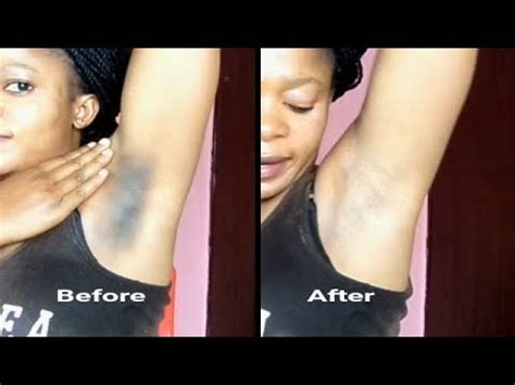 Online, article, story, explanation, suggestion, youtube. HOW TO LIGHTEN DARK BLACK UNDERARM INSTANTLY 100% WORKING ...