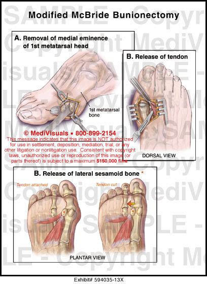 Modified Mcbride Bunionectomy Medical Illustration