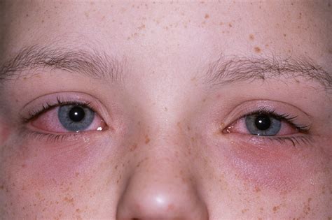Allergies Symptoms Nhs