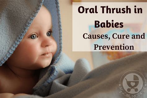 When we clean a baby's tongue, it loosens up and then removes the milk residue. Oral Thrush in Babies - Causes, Cure and Prevention