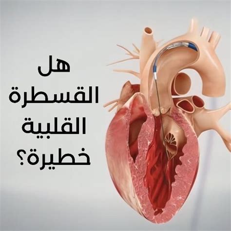 هل القسطرة القلبية خطيرة