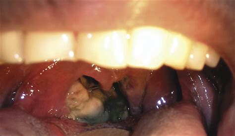 Mycosis Fungoides A Case Of Tonsil Involvement Dermatology Jama