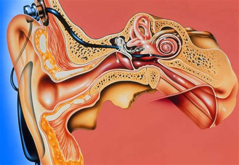 Cochlear Implant Anatomy