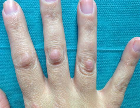Meredithgdesigns Arthritis Bumps On Joints