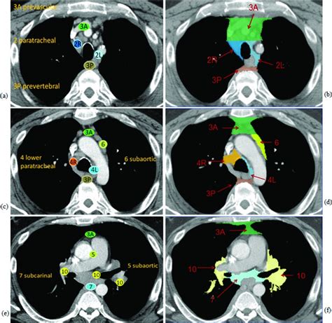 Mediastinal Lymph Node Detection And Station Mapping On Chest Ct Using
