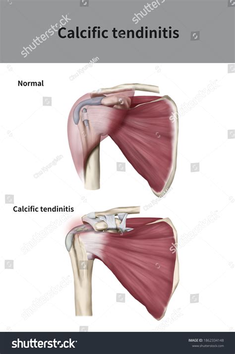 Medical D Illustration Explanation Calcific Tendinitis Stock