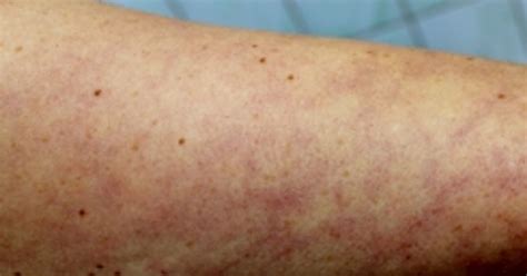 How Serious Is Mottled Skin Facty Health