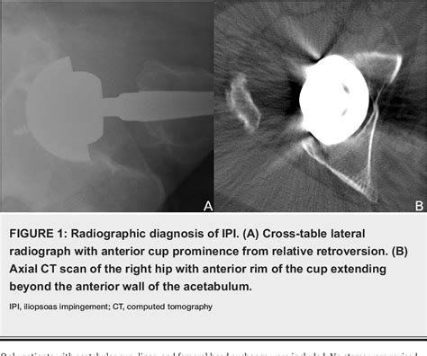 Figure 1 From Surgical Management Of Iliopsoas Impingement With