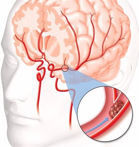 What To Know And Do When Your Brain Has Blood Clots New Health Advisor
