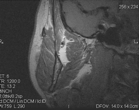 Mri Diagnostics Of The Masseter Muscles Condition At Muscularly