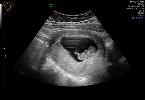 Baby Moving At 10 Weeks Ultrasound