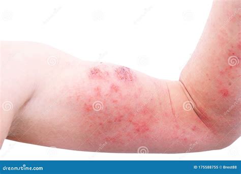 Atopic Dermatitis Ad Also Known As Atopic Eczema Is A Type Of