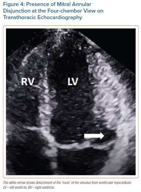 Presence Of Mitral Annular Disjunction At The Four Chamber View On