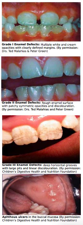 Celiac Disease Oral And Dental Manifestations A Panel Of Canadian
