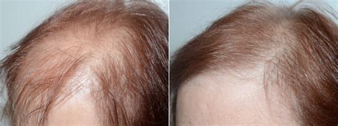 Everything You Need To Know About Women’s Hair Restoration Near Me ~ All About Best Hair Restoration