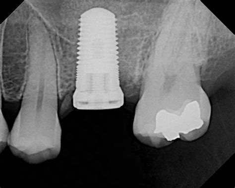 The cost also varies with how detailed of a physical is wanted. Dental Implant X-rays | Ramsey Amin, DDS