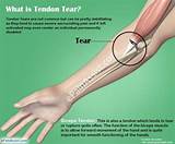 Pictures of Distal Bicep Tendon Tear Recovery Time
