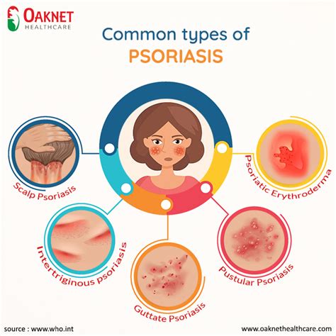 Common Types Of Psoriasis • Psoriasis Vulgaris — Inflammatory By