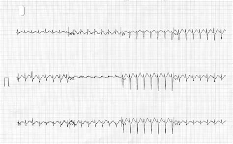 Ecg Class Keeping Ecgs Simple Describing The St Segment