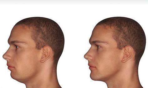 Mewing Before And After Ideas Jawline Temporomandibular Joint Mew