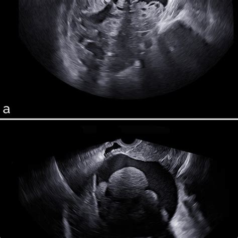 Transvaginal Ultrasound Of Solid Ovarian Masses A Clear Cell Ovarian