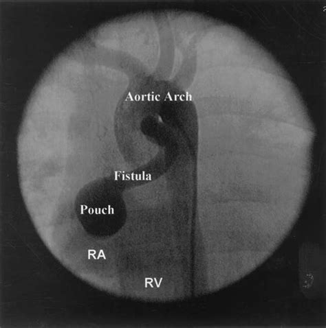 Left Anterior Oblique View Showing The Course Of The Fistula From The