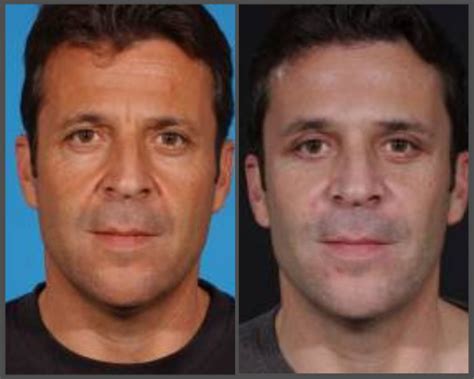 Midface Lift Surgery Before And After Plastic Surgeon Dallas Tx