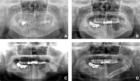 Panoramic View Of The Osteoradionecrosis Progression A Preoperative