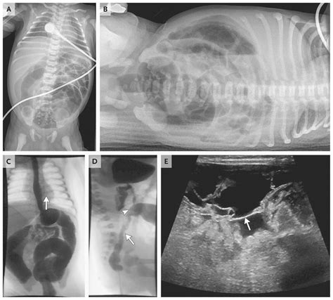 Case 3 2012 — A Newborn Boy With Vomiting Diarrhea And Abdominal
