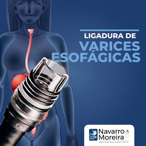 Ligadura De Varices Esofagicas Gastroenterologo Y Hepatologo