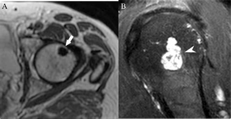 Mri Lesions Based On T2 Signal Intensity A Axial T2 Weighted Mri Image