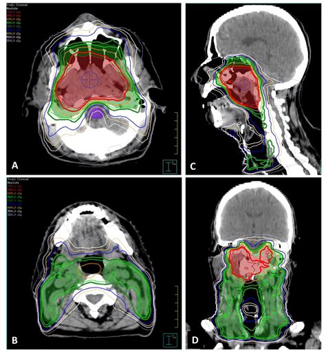 Successful Treatment Of Nasopharyngeal Cancer Using Radiotherapy With